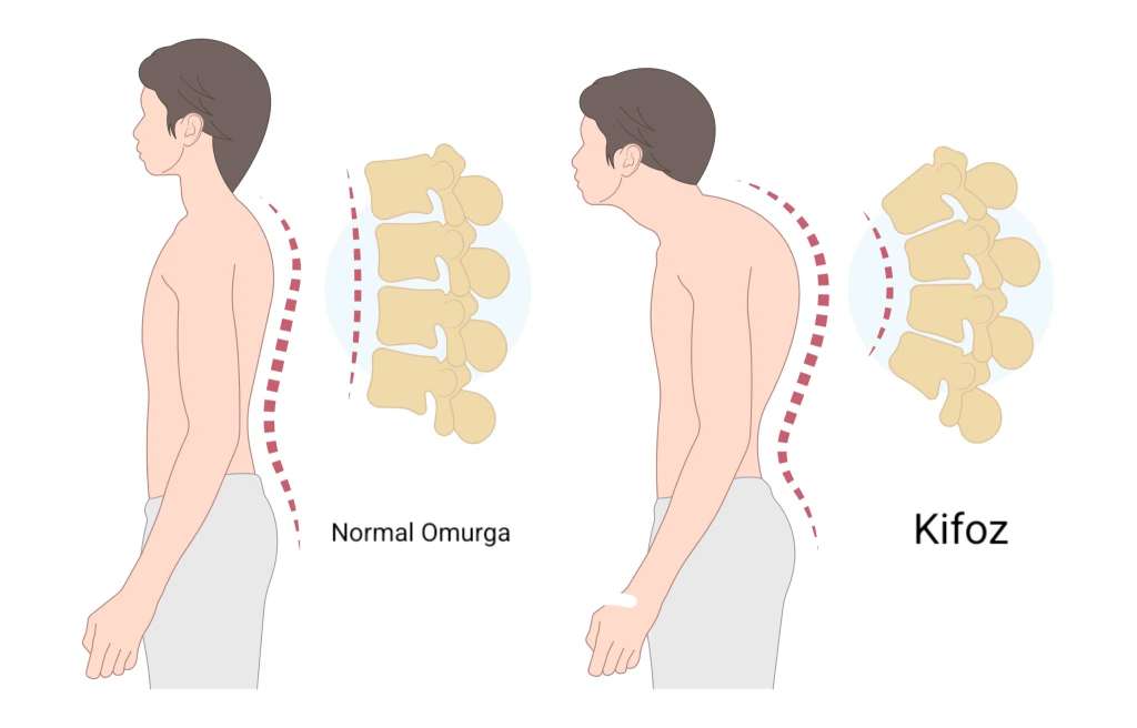 Kifoz (Kamburluk) Nedir?