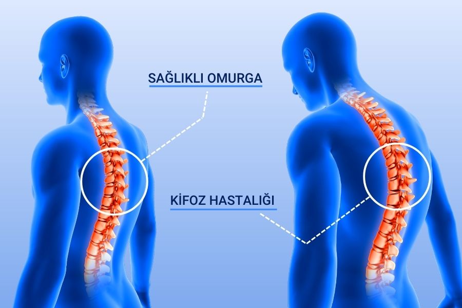 Kifoz (Kamburluk) Tanısı Nasıl Konulur?